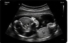 Ultrasound scan